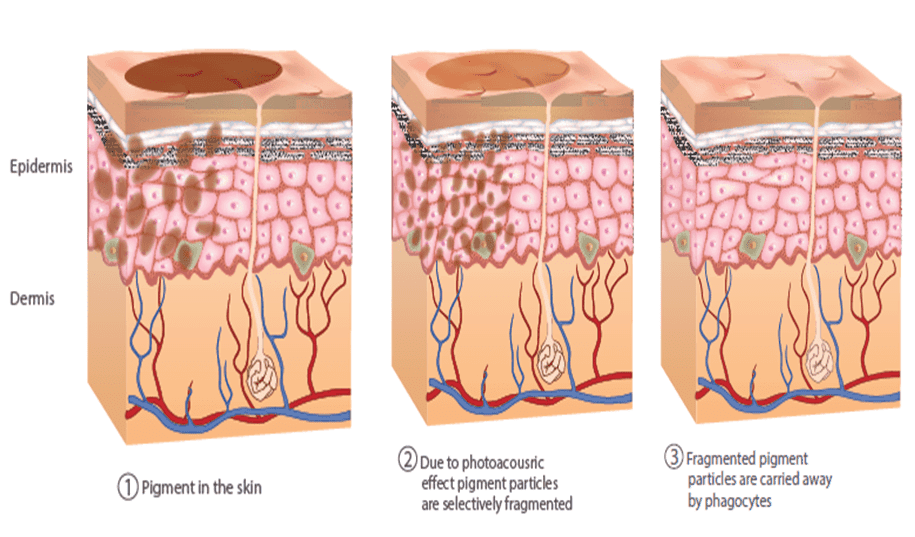 نحوه کار لیزر کیوسوئیچ
