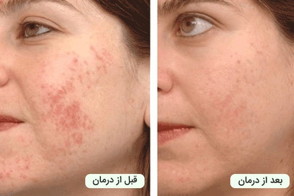 درمان تیرگی پوست با لیزر کیوسوئیچ