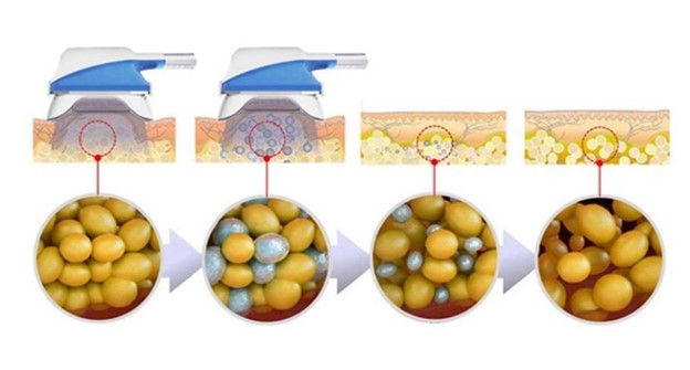 مکانیزم عملکرد کرایوایپولیز